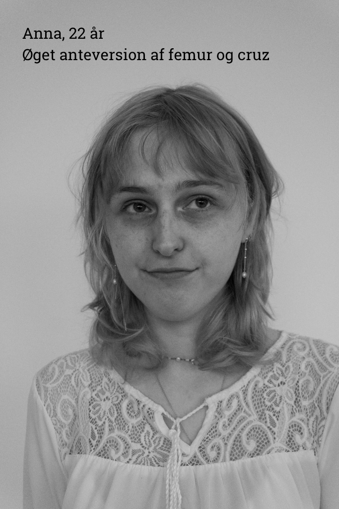 Anna, 22 år, Øget anteversion vecrus og femur Citat: "Jeg har selv oplevet, hvordan mit eget liv ændrede sig til det bedre på grund af en kommentar fra en anden. Derfor er jeg blevet fortæller, for at motivere til en større nysgerrighed på de mennesker omkring os."
